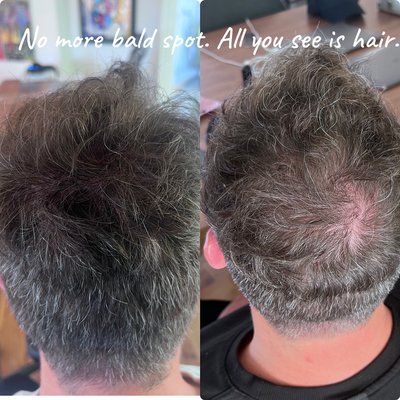 Scalp micro pigmentation - SMP is not only for scalp. It’s for beard too. Women and man can get this done. Scalp micro pigmentation - SMP is not only for scalp. It’s for beard too. Women and man can get this done.