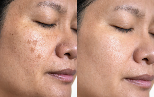 Before & After Results! - Who doesn't want to see REAL results?! Check out some of our past clients transformations! Book today for happier healthier skin! Before & After Results! - Who doesn't want to see REAL results?! Check out some of our past clients transformations! Book today for happier healthier skin!