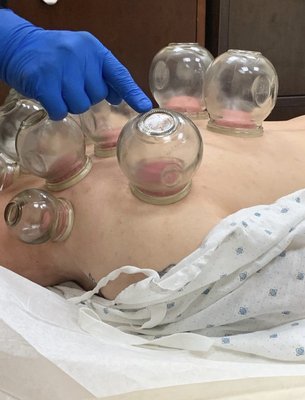 Cupping - I offer a variety of cupping services: General Cupping, Sports Cupping, Moving Cupping, and Hijiama Wet Cupping. This is one of the many treatments I offer within my customized plan for patients.