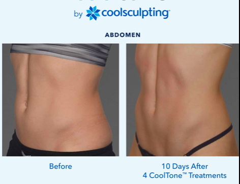 Cool Sculpting - CoolSculpting® and CoolSculpting® Elite are FDA-cleared for the treatment of visible fat bulges in the submental (under the chin) and submandibular (under the jawline) areas, thigh, abdomen, and flank, along with bra fat, back fat, underneath the buttocks (also known as banana roll), and upper arm. It is also FDA-cleared to affect the appearance of lax tissue with submental area treatments. CoolSculpting® and CoolSculpting® Elite are not treatments for weight loss. Cool Sculpting - CoolSculpting® and CoolSculpting® Elite are FDA-cleared for the treatment of visible fat bulges in the submental (under the chin) and submandibular (under the jawline) areas, thigh, abdomen, and flank, along with bra fat, back fat, underneath the buttocks (also known as banana roll), and upper arm. It is also FDA-cleared to affect the appearance of lax tissue with submental area treatments. CoolSculpting® and CoolSculpting® Elite are not treatments for weight loss.