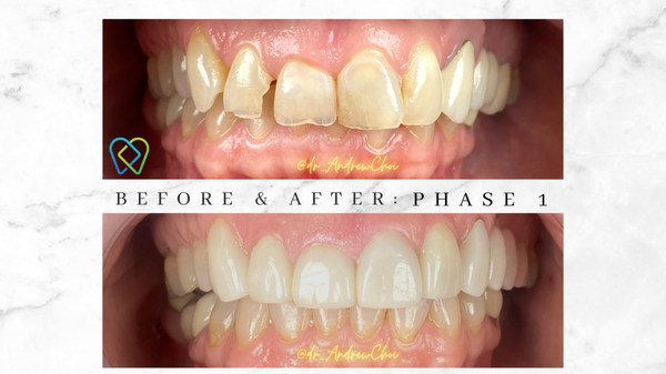 Veneers and Crowns - This patient came to us to fix her front teeth with cavities and fractures of her teeth. The patient was very happy with the results in fixing her teeth with veneer crowns. The patient opted out of doing any gum contouring. Veneers and Crowns - This patient came to us to fix her front teeth with cavities and fractures of her teeth. The patient was very happy with the results in fixing her teeth with veneer crowns. The patient opted out of doing any gum contouring.