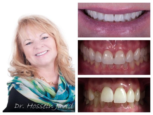 Full Mouth Smile make over/ Rehabilitation - This patient was refereed to us by her friend. She came in Very dissatisfied by the way her teeth looked and felt. She had been to multiple dentist trying to fix her teeth. She was told that she would have to remove her front 4 teeth because they were loose and no thought was put in to the cause. She wanted to restore all of her teeth. She was placed in temporaries for a period of time to stabilize her bite and establish an ideal smile before doing her final restorations. We took measures and staged her treatment over a 2 year period to help distribute the cost and make it more affordable for her.
She now feels like a whole new person and only wishes she had done it sooner. This is a signature case done by world-renowned master technicians. We do life-changing smile makeovers utilizing the latest minimally invasive treatment options and the latest technology. We take a team approach to making these life-changing smile transformations. We utilize the expertise of dental professionals specialized in all realms of dentistry to achieve the near-ideal results. She is extremely happy with the outcome and we are extremely happy to be able to give her a new smile.
-
We are passionate about caring for our patients. If you require dental care you can contact us to schedule your appointment. #Toothopia Full Mouth Smile make over/ Rehabilitation - This patient was refereed to us by her friend. She came in Very dissatisfied by the way her teeth looked and felt. She had been to multiple dentist trying to fix her teeth. She was told that she would have to remove her front 4 teeth because they were loose and no thought was put in to the cause. She wanted to restore all of her teeth. She was placed in temporaries for a period of time to stabilize her bite and establish an ideal smile before doing her final restorations. We took measures and staged her treatment over a 2 year period to help distribute the cost and make it more affordable for her.
She now feels like a whole new person and only wishes she had done it sooner. This is a signature case done by world-renowned master technicians. We do life-changing smile makeovers utilizing the latest minimally invasive treatment options and the latest technology. We take a team approach to making these life-changing smile transformations. We utilize the expertise of dental professionals specialized in all realms of dentistry to achieve the near-ideal results. She is extremely happy with the outcome and we are extremely happy to be able to give her a new smile.
-
We are passionate about caring for our patients. If you require dental care you can contact us to schedule your appointment. #Toothopia