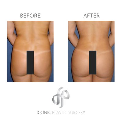 BBL Surgery - The Iconic Butt Lift is a popular fat grafting procedure that enhances buttock size and shape using the patient’s own fat, harvested through liposuction. Ideal candidates may have flat, sagging, or asymmetrical buttocks. The procedure takes 2-4 hours, with recovery around two weeks. Patients can expect initial results shortly after surgery, with final results developing over 9-12 months. The surgery aims to create a more appealing hourglass figure by combining buttock augmentation with fat reduction in problem areas.
For more details, visit Iconic Plastic Surgery. BBL Surgery - The Iconic Butt Lift is a popular fat grafting procedure that enhances buttock size and shape using the patient’s own fat, harvested through liposuction. Ideal candidates may have flat, sagging, or asymmetrical buttocks. The procedure takes 2-4 hours, with recovery around two weeks. Patients can expect initial results shortly after surgery, with final results developing over 9-12 months. The surgery aims to create a more appealing hourglass figure by combining buttock augmentation with fat reduction in problem areas.
For more details, visit Iconic Plastic Surgery.