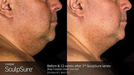 Sculpsure - SculpSure uses advanced lasers operating at a controlled wavelength that safely passes through your skin, then is absorbed by fat cells. The laser energy heats fat cells to the precise temperature needed to destroy fat tissue. Then the cellular waste from damaged fat cells is eliminated by the body through its lymphatic system. Sculpsure - SculpSure uses advanced lasers operating at a controlled wavelength that safely passes through your skin, then is absorbed by fat cells. The laser energy heats fat cells to the precise temperature needed to destroy fat tissue. Then the cellular waste from damaged fat cells is eliminated by the body through its lymphatic system.