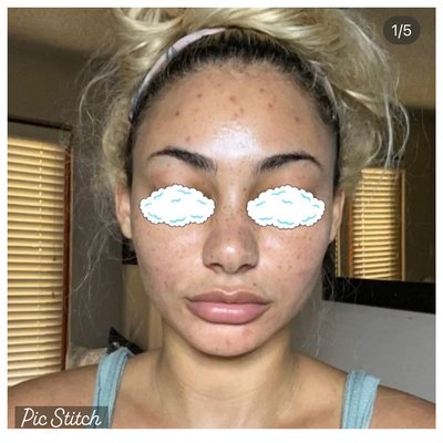 Acne - Acne healing and recovery Acne - Acne healing and recovery