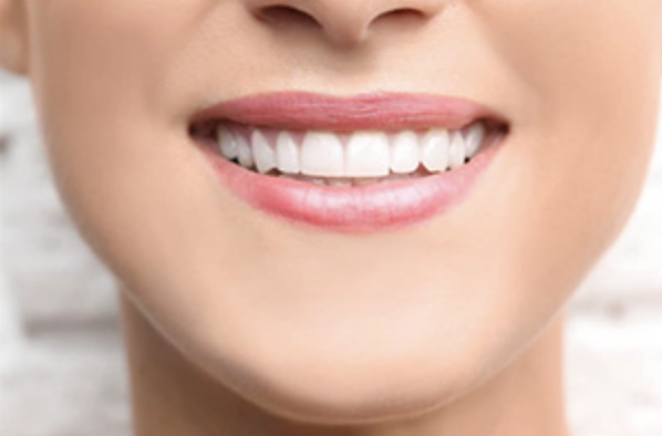 Dental Bonding - Dental bonding is a simple, conservative way to improve the appearance of your smile. Our dentists may recommend dental bonding when your teeth are discolored, gapped, or have other cosmetic flaws. Dental bonding uses tooth-colored material to correct these flaws so that you can enjoy a naturally beautiful smile for years to come. Dental Bonding - Dental bonding is a simple, conservative way to improve the appearance of your smile. Our dentists may recommend dental bonding when your teeth are discolored, gapped, or have other cosmetic flaws. Dental bonding uses tooth-colored material to correct these flaws so that you can enjoy a naturally beautiful smile for years to come.