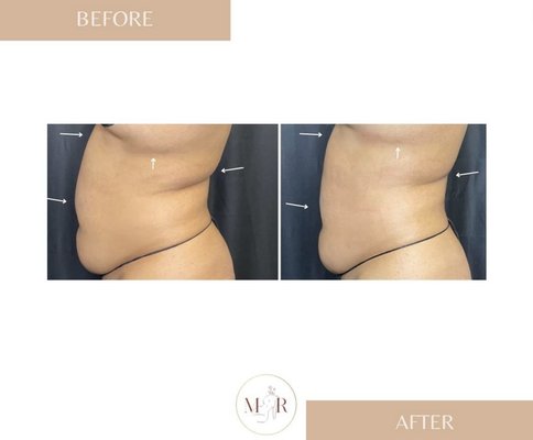 Fat Melting & Skin Tightening - Fat Melting & Skin Tightening sessions tighten and tone sagging skin as well as melts fat. Fat Melting & Skin Tightening - Fat Melting & Skin Tightening sessions tighten and tone sagging skin as well as melts fat.