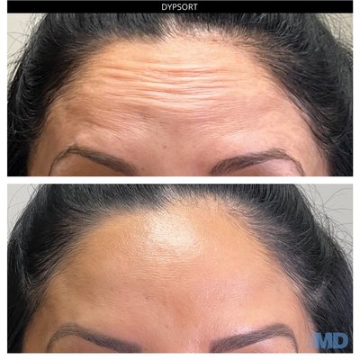 Fillers - Curious about the results of cosmetic injectables? See the stunning transformations we’ve achieved using advanced techniques in:
Undereye Filler – Brighten tired eyes and reduce hollowness for a refreshed, youthful appearance.
Nose Filler (Non-Surgical Rhinoplasty) – Subtly sculpt and balance your profile without surgery.
Facial Filler – Restore lost volume, enhance contours, and rejuvenate your natural beauty.
Lip Filler – From subtle definition to fuller volume, we create lips that enhance your features.
Chin Filler – Define and balance the lower face with natural-looking chin enhancement.
Dysport/Botox – Smooth fine lines and soften expression lines for a youthful, rested look.
Our gallery features real client results performed by trained professionals using premium products and techniques tailored to each individual Fillers - Curious about the results of cosmetic injectables? See the stunning transformations we’ve achieved using advanced techniques in:
Undereye Filler – Brighten tired eyes and reduce hollowness for a refreshed, youthful appearance.
Nose Filler (Non-Surgical Rhinoplasty) – Subtly sculpt and balance your profile without surgery.
Facial Filler – Restore lost volume, enhance contours, and rejuvenate your natural beauty.
Lip Filler – From subtle definition to fuller volume, we create lips that enhance your features.
Chin Filler – Define and balance the lower face with natural-looking chin enhancement.
Dysport/Botox – Smooth fine lines and soften expression lines for a youthful, rested look.
Our gallery features real client results performed by trained professionals using premium products and techniques tailored to each individual