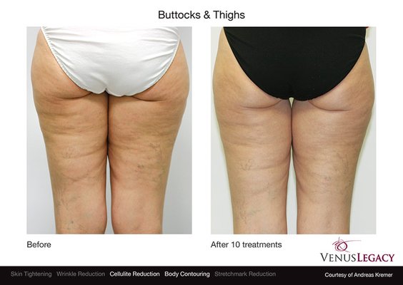 Venus Legacy - The highly advanced non-invasive medical device that effectively resolves challenging face and body aesthetic needs, such as non-surgical cellulite reduction and wrinkle reduction*. Treatments are comfortable with no downtime using RF technology that is safe for all skin types. Venus Legacy™ functions as a radio frequency machine for cellulite and is powered by proprietary (MP)2 technology (a combination of Multi-Polar Radio Frequency and Pulsed Electro Magnetic Fields) and features cutting-edge VariPulse™ technology. Venus Legacy - The highly advanced non-invasive medical device that effectively resolves challenging face and body aesthetic needs, such as non-surgical cellulite reduction and wrinkle reduction*. Treatments are comfortable with no downtime using RF technology that is safe for all skin types. Venus Legacy™ functions as a radio frequency machine for cellulite and is powered by proprietary (MP)2 technology (a combination of Multi-Polar Radio Frequency and Pulsed Electro Magnetic Fields) and features cutting-edge VariPulse™ technology.