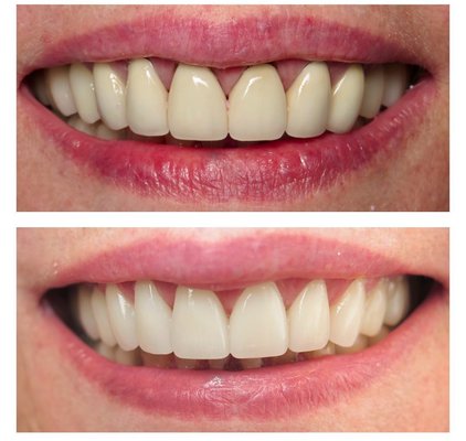 Aesthetic Dentistry - Porcelain Veneers - Porcelain veneers can be used to create a more symmetrical, full and bright smile. We work with a master ceramist to create natural looking veneers to enhance your smile.