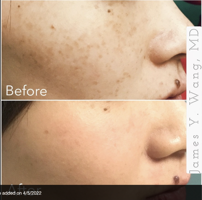 Pigmentation Treatment - We use a variety of pigment lasers, including the Hollywood Spectra, BBL/Halo, LaseMD Ultra, and other technologies to tackle hard to treat spots Pigmentation Treatment - We use a variety of pigment lasers, including the Hollywood Spectra, BBL/Halo, LaseMD Ultra, and other technologies to tackle hard to treat spots