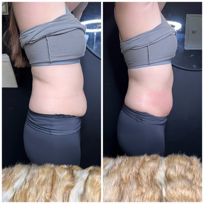 Summer makeover - Transformations like these are a testament to the power of effective body sculpting techniques. Our client initially sought to reduce fat in her mid-section but left with the toned and curvy look she had envisioned. This achievement underscores how tailored non-invasive procedures can specifically target problem areas, delivering results that align perfectly with individual goals. It's not just about losing inches; it's about sculpting and contouring the body to achieve a more confident and defined silhouette. Such success stories inspire others to explore how they too can achieve their desired body shape with our personalized approach to body sculpting. Summer makeover - Transformations like these are a testament to the power of effective body sculpting techniques. Our client initially sought to reduce fat in her mid-section but left with the toned and curvy look she had envisioned. This achievement underscores how tailored non-invasive procedures can specifically target problem areas, delivering results that align perfectly with individual goals. It's not just about losing inches; it's about sculpting and contouring the body to achieve a more confident and defined silhouette. Such success stories inspire others to explore how they too can achieve their desired body shape with our personalized approach to body sculpting.