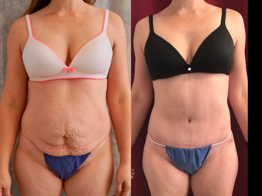 Tummy Tuck, Abdominoplasty,360 Liposuction - Tummy tuck or Abdominoplasty is a key component of our practice specialty, The Mommy Makeover. When combined with 360 or all the way around liposuction of the waist and back, the results of our tummy tucks are comprehensive and astounding! Dr. Lakshman and the staff of Pasadena Surgeons have taken care of literally thousands of tummy tuck patients over the years and our experience is second to none in the San Gabriel Valley. In fact, Dr. Lakshman has written a book based on his many years of experience titled "The Patient's Guide to A Perfect Tummy Tuck." You can find the link on our website at www.pasadenasurgeons.com or on Amazon. Tummy Tuck, Abdominoplasty,360 Liposuction - Tummy tuck or Abdominoplasty is a key component of our practice specialty, The Mommy Makeover. When combined with 360 or all the way around liposuction of the waist and back, the results of our tummy tucks are comprehensive and astounding! Dr. Lakshman and the staff of Pasadena Surgeons have taken care of literally thousands of tummy tuck patients over the years and our experience is second to none in the San Gabriel Valley. In fact, Dr. Lakshman has written a book based on his many years of experience titled "The Patient's Guide to A Perfect Tummy Tuck." You can find the link on our website at www.pasadenasurgeons.com or on Amazon.