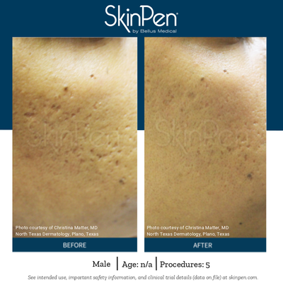 Microneedling - Skin Pen - What Is Microneedling?

Microneedling stimulates new collagen in the skins surface by creating very small micro-channels using micro-needles. The Microneedling SkinPen device utilizes a one time use (disposable) cartridge that contains 14 stainless steel microneedles that can penetrate the skin at different depths. These micro-needles will cause a controlled injury in the skins surface, boosting or inducing your own natural collagen.


Treatment Information
What Is Microneedling?

Microneedling stimulates new collagen in the skins surface by creating very small micro-channels using micro-needles. The Microneedling SkinPen device utilizes a one time use (disposable) cartridge that contains 14 stainless steel microneedles that can penetrate the skin at different depths. These micro-needles will cause a controlled injury in the skins surface, boosting or inducing your own natural collagen.

What Should I Expect With Microneedling?

Once micro-channels are created in the skin surface it will heal (in about 2-3 days) and began the process of replacing it with brand new collagen and elastin (in about 4 weeks) overall improving the skin health and wellness.

Is It Safe?

Yes, the SkinPen is the first microneedling device cleared by the FDA. SkinPen’s patent-pending single-use sterile needle cartridge is built with safety in mind. The SkinPen device is also surrounded by a propriety BioSheath Protection that acts as a barrier to prevent cross contamination between procedures.   

Who Is The Treatment For?

Works for all skin types – dark to light.  SkinPen has been clinically shown to be effective for women and men for acne scars and anti-aging

Click to our website shawskinclinic.com to book your appointment today. 12 years experience with Microneedling, 6 years in business.