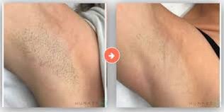 Laser Hair Removal - Laser hair removal is used to reduce unwanted hair. Common treatment locations include legs, armpits, upper lip, chin and the bikini line. Laser Hair Removal - Laser hair removal is used to reduce unwanted hair. Common treatment locations include legs, armpits, upper lip, chin and the bikini line.