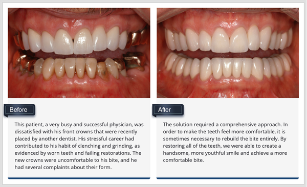 Crowns - Crowns are restorations that are similar to veneers, except they cover the entire tooth. They are used to fix teeth that are badly damaged or worn, have large cavities, or have undergone root canal therapy. Crowns are also used to strengthen weakened teeth. Adjacent crowns can be connected together to stabilize loose teeth.
Crowns can be constructed from various materials. No matter the material or construction technique, crowns can help restore the look, strength and bite function of natural teeth. Crowns - Crowns are restorations that are similar to veneers, except they cover the entire tooth. They are used to fix teeth that are badly damaged or worn, have large cavities, or have undergone root canal therapy. Crowns are also used to strengthen weakened teeth. Adjacent crowns can be connected together to stabilize loose teeth.
Crowns can be constructed from various materials. No matter the material or construction technique, crowns can help restore the look, strength and bite function of natural teeth.