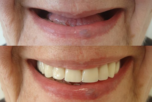 Dentures Transformation - Life-changing smile makeover! ✨ This patient came to us without teeth, and with a custom set of complete dentures, they now have a beautiful, functional smile. Confidence restored, comfort regained! 😁 Ready for your own transformation? Schedule a consultation today! #CompleteDentures #SmileRestored Dentures Transformation - Life-changing smile makeover! ✨ This patient came to us without teeth, and with a custom set of complete dentures, they now have a beautiful, functional smile. Confidence restored, comfort regained! 😁 Ready for your own transformation? Schedule a consultation today! #CompleteDentures #SmileRestored