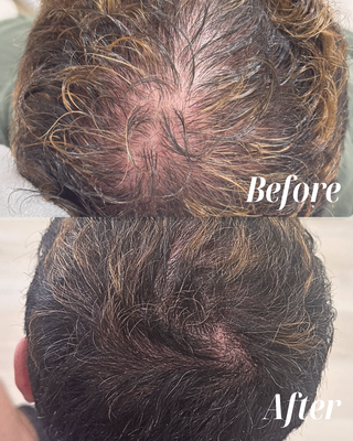 PRF Hair Growth - PRF Hair Restoration is a non-surgical treatment that uses your body’s own platelet-rich plasma to stimulate hair follicles and encourage natural hair regrowth. By delivering concentrated growth factors directly to the scalp, PRP can improve hair density, strengthen existing strands, and slow down hair thinning. It’s a safe, effective option for both men and women experiencing early to moderate hair loss. PRF Hair Growth - PRF Hair Restoration is a non-surgical treatment that uses your body’s own platelet-rich plasma to stimulate hair follicles and encourage natural hair regrowth. By delivering concentrated growth factors directly to the scalp, PRP can improve hair density, strengthen existing strands, and slow down hair thinning. It’s a safe, effective option for both men and women experiencing early to moderate hair loss.