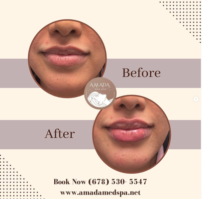 Before and After Transformations - Take a peek at our breathtaking before and after pictures that showcase the incredible results our clients have achieved. See the undeniable proof of the transformative effects lip fillers can have on your overall look, boosting your confidence and leaving you feeling fabulous.k out our most recent lip filler looks.
Whether you desire a subtle enhancement or a more dramatic change, our skilled injectors will work closely with you to understand your unique goals and craft a personalized treatment plan. We believe in enhancing your natural beauty, allowing your individuality to shine through.
Say goodbye to thin, lackluster lips and say hello to a captivating smile that steals the spotlight. Our Lip Filler Transformation is your key to achieving the perfect pout you've always dreamed of.
Join countless satisfied clients who have experienced the magic of our lip filler treatments. Don't miss out on the opportunity to transform your look and boost your self-esteem. Contact us today to schedule your consultation and take the first step towards a more beautiful you! Before and After Transformations - Take a peek at our breathtaking before and after pictures that showcase the incredible results our clients have achieved. See the undeniable proof of the transformative effects lip fillers can have on your overall look, boosting your confidence and leaving you feeling fabulous.k out our most recent lip filler looks.
Whether you desire a subtle enhancement or a more dramatic change, our skilled injectors will work closely with you to understand your unique goals and craft a personalized treatment plan. We believe in enhancing your natural beauty, allowing your individuality to shine through.
Say goodbye to thin, lackluster lips and say hello to a captivating smile that steals the spotlight. Our Lip Filler Transformation is your key to achieving the perfect pout you've always dreamed of.
Join countless satisfied clients who have experienced the magic of our lip filler treatments. Don't miss out on the opportunity to transform your look and boost your self-esteem. Contact us today to schedule your consultation and take the first step towards a more beautiful you!