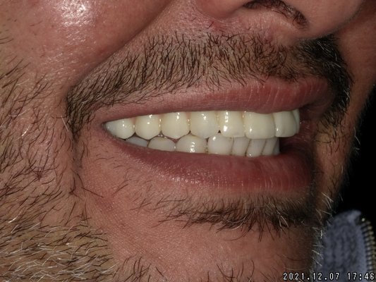 ALL ON X Implants - Fully edentulous upper jaw was restored with fixed prosthesis on 6 implants
