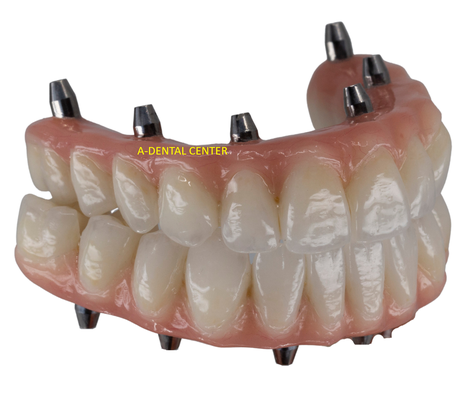 All-On-4 and All-On-6 Full Mouth Implant Bridge or Denture - The All-on-4 dental implant procedure is a modern and innovative solution for individuals who have lost most or all of their teeth in one or both jaws. Unlike traditional dental implants, which require a separate implant for each missing tooth, the All-on-4 technique allows for the attachment of a full arch of teeth (either upper or lower) to often just four or six strategically placed implants.

The procedure involves the insertion of four dental implants into the jawbone, typically at specific angles to maximize stability and utilize available bone. These implants serve as anchors for a custom-made dental prosthesis, which can be either a fixed bridge or removable overdenture. The prosthetic teeth are carefully designed to look, feel, and function like natural teeth, restoring the patient's ability to chew, speak, and smile confidently.

One of the significant advantages of the All-on-4 procedure is that it often reduces the need for bone grafting in patients with insufficient bone volume, as the angled placement of implants often utilizes the available bone more effectively. This can result in a shorter overall treatment time and a quicker recovery for the patient.

Overall, the All-on-4 dental implant technique provides a cost-effective and efficient solution for individuals seeking a full arch of replacement teeth with improved stability and functionality. It offers a long-term, aesthetically pleasing result for patients suffering from extensive tooth loss.
