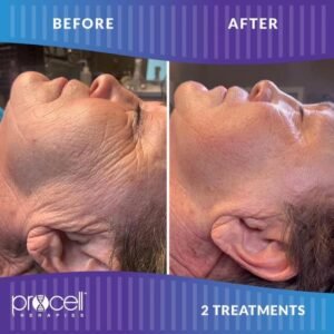 PROCELL MD Microchanneling Sessions - At BLK BMR Skin Bar, our advanced Microchanneling MD treatments go beyond surface fixes. Clients often come in with acne scars, fine lines, thinning hair, or dull, inflamed skin and after just 3 sessions, they leave with visibly smoother, plumper, more radiant skin that actually heals from within.

Think reduced acne scars, softened wrinkles, and even hair regrowth—without the frozen look of injectables. It's not overnight magic, but it's real science-backed skin regeneration. Most clients continue maintenance sessions, but the transformation after just a few is jaw-dropping.

Come see what your skin can really do when you give it the right tools. 💥