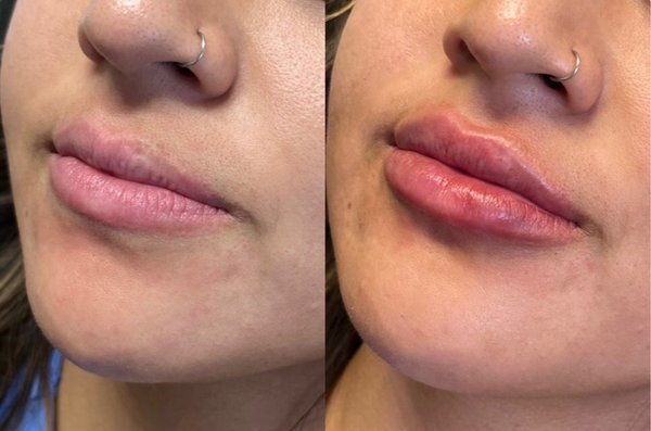 Filler Lips - Lip fillers are used to restore lost volume and treat other signs of aging. Our team uses dermal filler products like Juvederm and Restylane to help you achieve a more plump, defined, symmetrical lip appearance. During your visit, you will discuss your goals and desires with your injector, and together, you will devise a plan to achieve your look.