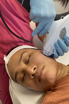 V-FR (Ablative Fractional Radiofrequency) - This treatment is V-FR (Ablative Fractional Radiofrequency) that uses bi-polar RF to safely and effectively target various skin concerns including acne scarring, stretch marks, enlarged pores, skin resurfacing and rejuvenating, texture improvement, and skin tightening. This service is sold in packages of 6 sessions for effective results and a consultation is required prior to booking this service.