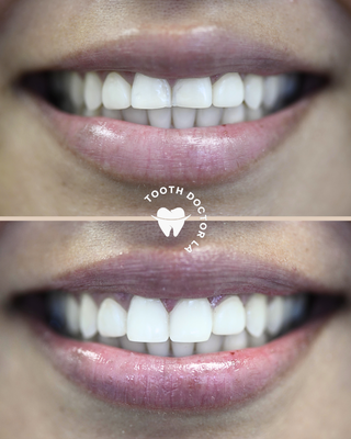 Composite Bonding - Complete with no drilling of the teeth, no damage to them and no needles / injections involved either, composite bonding is a very popular smile makeover treatment. The white composite material builds upon the natural teeth - enhancing their shape, size and symmetry while also fixing chips and closing some gaps between them too. Most composite bonding cases take just one single appointment to complete. Composite Bonding - Complete with no drilling of the teeth, no damage to them and no needles / injections involved either, composite bonding is a very popular smile makeover treatment. The white composite material builds upon the natural teeth - enhancing their shape, size and symmetry while also fixing chips and closing some gaps between them too. Most composite bonding cases take just one single appointment to complete.