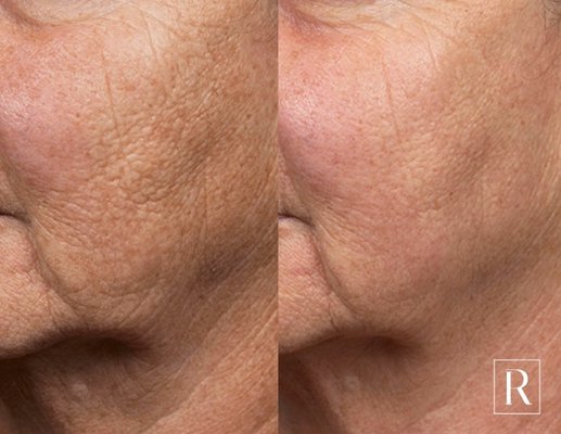 Fraxel - Fraxel is one of the leading non-ablative fractional lasers available on the market. It uses controlled laser heating to improve a wide range of skin imperfections, such as scars, wrinkles and large pores. In this way, our Fraxel treatments have the ability to improve the quality of your skin, while restoring a more attractive facial appearance.
Fraxel can:
Improve the appearance of fine lines and deep wrinkles
Treat sun damage and age spots
Reduce acne scars
Make pores appear less visible
Tighten lax skin
Enhance your skin tone
Restore a healthy and youthful complexion Fraxel - Fraxel is one of the leading non-ablative fractional lasers available on the market. It uses controlled laser heating to improve a wide range of skin imperfections, such as scars, wrinkles and large pores. In this way, our Fraxel treatments have the ability to improve the quality of your skin, while restoring a more attractive facial appearance.
Fraxel can:
Improve the appearance of fine lines and deep wrinkles
Treat sun damage and age spots
Reduce acne scars
Make pores appear less visible
Tighten lax skin
Enhance your skin tone
Restore a healthy and youthful complexion