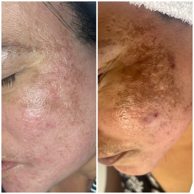 BEFORE AND AFTERS CLINICAL SKINCARE - These beautiful ladies came to me with concerns of roseacea and melasma with acne scarring. I treated both with care and thought and I put them on home regimens as well as monthly visits to come see me in the treatment room. Hope to see you next!