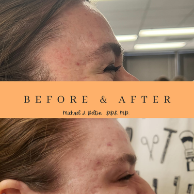 Crow's feet minimized! - Anytime you are making a change to your face, you want people to notice but no so much that they question whether or not it is fake. Botox change is real and only take a few days see a difference.