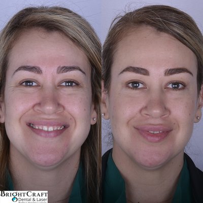 Injections - WE offer, Juvederm and Restylane fillers.
We offer, Botox and Dysport.
If you are not sure which one do you need we offer FREE consultation. Just call us at (747)241-8800 to schedule your consultation appointment. Injections - WE offer, Juvederm and Restylane fillers.
We offer, Botox and Dysport.
If you are not sure which one do you need we offer FREE consultation. Just call us at (747)241-8800 to schedule your consultation appointment.