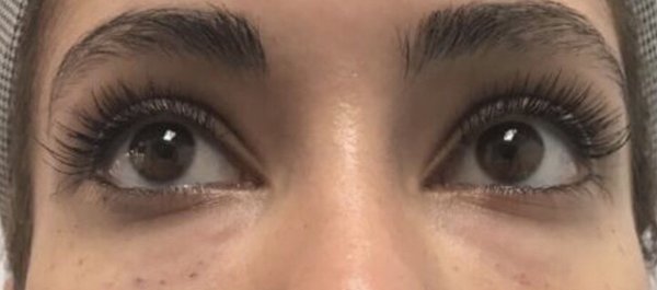 Under Eye Filler - The eyes have it! Eliminate dark circles and bags without surgery, pain or downtime. Our eye revive treatment enhances your eyes and lasts up to one year. Under Eye Filler - The eyes have it! Eliminate dark circles and bags without surgery, pain or downtime. Our eye revive treatment enhances your eyes and lasts up to one year.