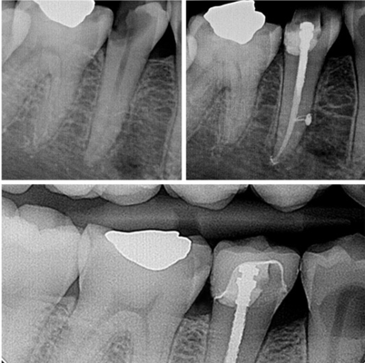 Root Canals - Root Canal Cases Root Canals - Root Canal Cases