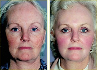 Chemical Peels - While chemical peels have been in use for decades, Dr. Rex Moulton-Barrett offers only advanced options that are safe, affordable, and effective. With choices such as the Obagi Blue Peel®, the Perfect Peel, and the Phenol Peel. Chemical peels in our Alameda and Brentwood practice can smooth and brighten even the most tired, blotchy, or damaged skin.

We offer a range of clinically proven chemical peels from light peels to deep peels formulated with several types of acids to address your personal concerns.

To find out more about how a chemical peel can renew the appearance and texture of your skin, request a consultation using our online form.

Who Can Benefit From Chemical Peels?
There are a number of skin conditions and concerns that a chemical peel can address for people of all skin types. Because chemical peels can be irritating, people with sensitive skin are not always good candidates for these treatments. Common skin concerns our chemical peel patients come to us for help with include:

Fine surface wrinkles
Acne scarring
Unfavorable skin texture
Rough skin
Blotchy skin
Coarse facial wrinkles
Superficial blemishes
Some of these concerns can be addressed with multiple treatments, including non-invasive options such as laser skin resurfacing. What will be best for your specific skin type and severity of concern is determined during a consultation with Dr. Rex Moulton-Barrett who can describe the options you have for facial rejuvenation and recommend a personalized treatment plan.