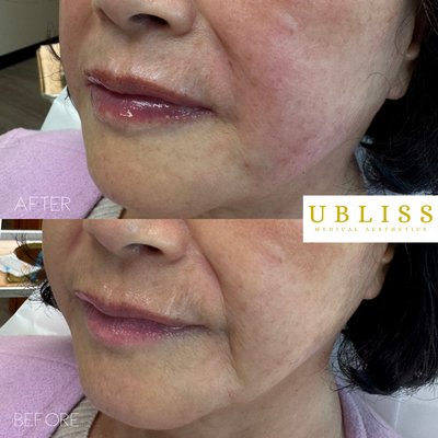 ✨ Sculpt & Refresh Your Smile with Radiesse @radiesse & HA Fillers @therhacollection ! ✨ - Banish chin shadows, marionette lines, and deep smile lines with a perfect blend of Radiesse and Hyaluronic Acid (HA) fillers! 💉 Smooth, lift, and restore volume for a naturally youthful and defined look—plus, enhance your lips for that perfect pout! 💋
📍 Limited-Time Special at Ubliss Medical Aesthetics
💎 Expert techniques for balanced, natural results.
📩 Contact us to book your consultation!
Stella Nam, RN, BSN, AAOPM-Certified
Founder & Lead Provider
Ubliss Medical Aesthetics
📍 214-41 42nd Avenue, Suite 3C, Bayside, NY 11361
📞 (631) 616-5615
📧 info@ublissny.com
🌐 www.ublissny.com
📲 Follow us on Instagram: @ublissny
🏆 National Recommended Provider – The Best Aesthetic Injectors in America
🏆 2023 & 2024 & 2025 Best in Business Medical Spa – BNS News
🏆 2024 Trust Award Winner – Winner Magazine, BNS News
🔹 AAOPM Board-Certified in Aesthetic & Functional Medicine
🔹 Featured in Top 10 Aesthetic Injectors You Need to Know – Fab World Today
📺 Featured on The Donna Drake Show | CBS ✨ Sculpt & Refresh Your Smile with Radiesse @radiesse & HA Fillers @therhacollection ! ✨ - Banish chin shadows, marionette lines, and deep smile lines with a perfect blend of Radiesse and Hyaluronic Acid (HA) fillers! 💉 Smooth, lift, and restore volume for a naturally youthful and defined look—plus, enhance your lips for that perfect pout! 💋
📍 Limited-Time Special at Ubliss Medical Aesthetics
💎 Expert techniques for balanced, natural results.
📩 Contact us to book your consultation!
Stella Nam, RN, BSN, AAOPM-Certified
Founder & Lead Provider
Ubliss Medical Aesthetics
📍 214-41 42nd Avenue, Suite 3C, Bayside, NY 11361
📞 (631) 616-5615
📧 info@ublissny.com
🌐 www.ublissny.com
📲 Follow us on Instagram: @ublissny
🏆 National Recommended Provider – The Best Aesthetic Injectors in America
🏆 2023 & 2024 & 2025 Best in Business Medical Spa – BNS News
🏆 2024 Trust Award Winner – Winner Magazine, BNS News
🔹 AAOPM Board-Certified in Aesthetic & Functional Medicine
🔹 Featured in Top 10 Aesthetic Injectors You Need to Know – Fab World Today
📺 Featured on The Donna Drake Show | CBS