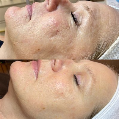 Facial Glow Ups - Bare Necessities has highly trained esthetician who are knowledgeable in all skin types and concerns. We specialize in custom facials that are highly relaxing!
