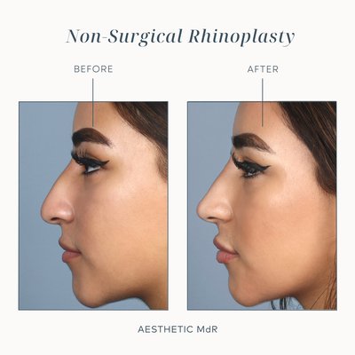Non-Surgical Rhinoplasty - Non-surgical rhinoplasty is a quick and painless procedure, during which fillers such as Restalyne, Voluma and Radiesse are injected in order to achieve a more harmonious nasal structure.