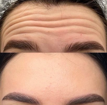 Natural Botox results - At Bloom Skin Clinic, our Botox and Dysport treatments are designed to soften fine lines while maintaining natural facial movement. Each treatment is customized to enhance a refreshed and balanced appearance.