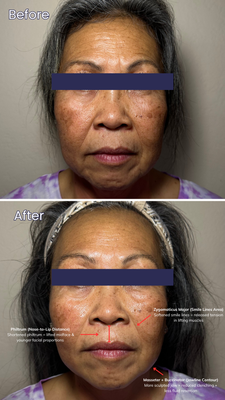 Natural Lift: Anti-Aging Buccal Massage Results - Before and after from a buccal massage facial—targeting jaw tension, TMJ relief, and natural anti-aging without injectables.

We focused on facial sculpting, muscle release, and lymphatic drainage to lift the cheeks, soften smile lines, and define the jawline. Results shown after just one session.

Perfect for clients seeking a non-invasive facelift, TMJ support, or alternatives to Botox and filler.