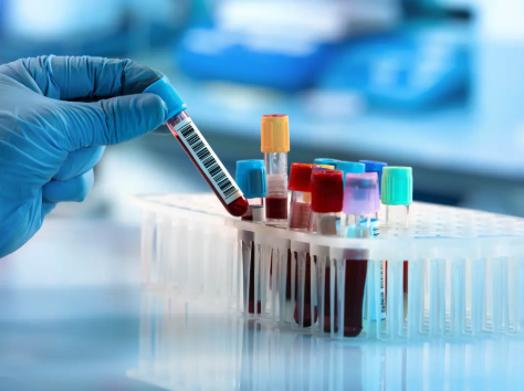 On-Site Labs - On-Site Labs at AFC Urgent Care Rowlett!
When you need lab testing in Rowlett, TX, done quickly and accurately, AFC Rowlett is here to help. Our urgent care centers feature on-site lab services that deliver fast results, with no need to visit an off-site facility or wait days for answers. Whether you need routine blood work, screenings for specific conditions, or diagnostic testing after exposure to an illness, AFC combines trusted medical expertise with the convenience of walk-in service.
Comprehensive Lab Tests We Offer:
AFC makes lab testing in Rowlett simple, accessible, and affordable. With no appointments required, you can simply walk in whenever it’s convenient for you, saving time compared to ER visits or off-site labs. We feature an on-site blood test lab at AFC Rowlett, ensuring samples are processed right here, so you get answers faster and avoid unnecessary delays. Our friendly, certified technicians are just minutes away, ready to provide care tailored to your needs.
-A1C and Glucose Blood Tests: Monitor and manage diabetes or pre-diabetes with quick, reliable blood sugar testing.
-Complete Blood Count (CBC): Evaluate overall health and detect conditions such as anemia or infection with a single, comprehensive test.
-Comprehensive Metabolic Panel (CMP): Check electrolytes, kidney function, and other key health indicators for a complete wellness snapshot with our CMP test.
-AST, ALT, and Liver Function Tests: Assess liver health and identify potential concerns early with targeted testing.
-Lipid Panel and Cholesterol Screening: Measure cholesterol and triglyceride levels to evaluate heart health and risk factors.
-BNP and Cardiac Marker Testing: Screen for potential heart failure or cardiac stress with advanced, on-site blood work.
-Allergy and ANA Blood Tests: Identify allergies or autoimmune conditions with precise lab diagnostics.
-CRP, ESR, and Inflammatory Panels: Detect inflammation in the body to help guide diagnosis and treatment.
-STD and Tuberculosis Testing: Get confidential screening for sexually transmitted infections or TB exposure with same-day availability.
-Urine Analysis and UTI Testing: Quickly confirm urinary tract infections or monitor kidney function with in-house testing.
-Pregnancy and HCG Tests: Receive accurate pregnancy results in minutes, without the wait.
-RSV, Flu, and COVID Testing: Detect respiratory infections, such as RSV and COVID-19, rapidly with on-site molecular or antigen testing options.
Walk in to our clinic today at 4724 Lakeview Pkwy, Suite 300, Rowlett, TX 75088.
Also, feel free to call AFC Rowlett today at (945) 288-2483 for more information. On-Site Labs - On-Site Labs at AFC Urgent Care Rowlett!
When you need lab testing in Rowlett, TX, done quickly and accurately, AFC Rowlett is here to help. Our urgent care centers feature on-site lab services that deliver fast results, with no need to visit an off-site facility or wait days for answers. Whether you need routine blood work, screenings for specific conditions, or diagnostic testing after exposure to an illness, AFC combines trusted medical expertise with the convenience of walk-in service.
Comprehensive Lab Tests We Offer:
AFC makes lab testing in Rowlett simple, accessible, and affordable. With no appointments required, you can simply walk in whenever it’s convenient for you, saving time compared to ER visits or off-site labs. We feature an on-site blood test lab at AFC Rowlett, ensuring samples are processed right here, so you get answers faster and avoid unnecessary delays. Our friendly, certified technicians are just minutes away, ready to provide care tailored to your needs.
-A1C and Glucose Blood Tests: Monitor and manage diabetes or pre-diabetes with quick, reliable blood sugar testing.
-Complete Blood Count (CBC): Evaluate overall health and detect conditions such as anemia or infection with a single, comprehensive test.
-Comprehensive Metabolic Panel (CMP): Check electrolytes, kidney function, and other key health indicators for a complete wellness snapshot with our CMP test.
-AST, ALT, and Liver Function Tests: Assess liver health and identify potential concerns early with targeted testing.
-Lipid Panel and Cholesterol Screening: Measure cholesterol and triglyceride levels to evaluate heart health and risk factors.
-BNP and Cardiac Marker Testing: Screen for potential heart failure or cardiac stress with advanced, on-site blood work.
-Allergy and ANA Blood Tests: Identify allergies or autoimmune conditions with precise lab diagnostics.
-CRP, ESR, and Inflammatory Panels: Detect inflammation in the body to help guide diagnosis and treatment.
-STD and Tuberculosis Testing: Get confidential screening for sexually transmitted infections or TB exposure with same-day availability.
-Urine Analysis and UTI Testing: Quickly confirm urinary tract infections or monitor kidney function with in-house testing.
-Pregnancy and HCG Tests: Receive accurate pregnancy results in minutes, without the wait.
-RSV, Flu, and COVID Testing: Detect respiratory infections, such as RSV and COVID-19, rapidly with on-site molecular or antigen testing options.
Walk in to our clinic today at 4724 Lakeview Pkwy, Suite 300, Rowlett, TX 75088.
Also, feel free to call AFC Rowlett today at (945) 288-2483 for more information.