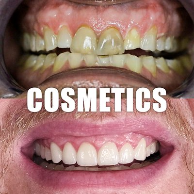 Cosmetics - Whether it is gum lifts or Crowns we will give you a beautiful smile makeover. Cosmetics - Whether it is gum lifts or Crowns we will give you a beautiful smile makeover.