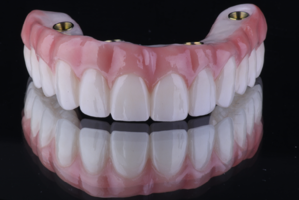From Wood to Wonder: The Evolution of Dentures - Let's take a journey through the fascinating history of dentures," Dr. Anna Aller began. "For centuries, people have sought solutions to restore their smiles after losing their teeth. The earliest dentures were rudimentary, made from materials like wood, bone, and even animal teeth. While these early dentures provided some functionality, they were often uncomfortable and not very durable.

As dentistry advanced, the 18th and 19th centuries saw significant improvements. Dentures made from ivory and porcelain became more common, offering a more realistic appearance. However, these materials were still far from perfect. They could be heavy and prone to breaking.

The real breakthrough came in the 20th century with the development of acrylic resin. This material allowed for the creation of removable complete dentures that were lighter, more comfortable, and more natural-looking. These dentures became a popular solution for many people, restoring their ability to eat, speak, and smile with confidence.

However, removable dentures still had their drawbacks. They could slip or cause sore spots, and they didn't provide the same stability as natural teeth. This is where modern technology and planning come into play, leading us to the innovation of All-on-4 implants.

All-on-4 is a revolutionary approach that uses four strategically placed dental implants to support a fixed denture. Unlike removable dentures, All-on-4 implants offer a stable and permanent solution. They feel and function much like natural teeth, allowing patients to eat their favorite foods, speak clearly, and smile without worry.

"What's truly amazing about All-on-4 is the precision and planning involved. Advanced imaging technology allows us to create a detailed map of a patient's jawbone, ensuring that the implants are placed in the optimal positions. This not only maximizes stability but also minimizes discomfort and healing time.

In summary, the evolution from rudimentary wooden dentures to advanced All-on-4 implants represents a remarkable journey in dental care. Today, we have the technology and expertise to provide solutions that significantly improve patients' quality of life, restoring both function and confidence in their smiles."
