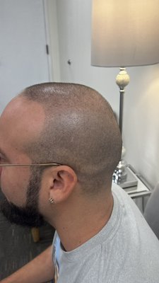 Microblading, Chemical Peels Facial, Hydrafacial Scalp micropigmentation - We're experts at what we do. But knowing the best techniques is only part of the process, we're also here to make you feel great. Whether you're here for a Facial or Microblading in Walnut Creek area, your happiness is of utmost importance. Microblading, Chemical Peels Facial, Hydrafacial Scalp micropigmentation - We're experts at what we do. But knowing the best techniques is only part of the process, we're also here to make you feel great. Whether you're here for a Facial or Microblading in Walnut Creek area, your happiness is of utmost importance.