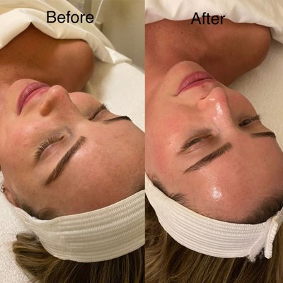 Hydra-dermabrasion Facial - Known as the “celebrity facial”, hydra-dermabrasion is the latest and greatest way to remove dead cells from the skin to eliminate dark spots and hyperpigmentation. With no downtime or aftercare, this new technology uses water and oxygen to effortlessly exfoliate the skin while infusing the skin with peptides, minerals, and vitamins. The treatment will include ultrasonic and micro-current technology to tighten the skin and will give you an immediate “wow” factor in less than 60 minutes! Hydra-dermabrasion Facial - Known as the “celebrity facial”, hydra-dermabrasion is the latest and greatest way to remove dead cells from the skin to eliminate dark spots and hyperpigmentation. With no downtime or aftercare, this new technology uses water and oxygen to effortlessly exfoliate the skin while infusing the skin with peptides, minerals, and vitamins. The treatment will include ultrasonic and micro-current technology to tighten the skin and will give you an immediate “wow” factor in less than 60 minutes!