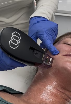 RF Microneedling Treatment - Advanced RF microneedling treatments designed to improve skin texture, tone, and firmness with minimal downtime.