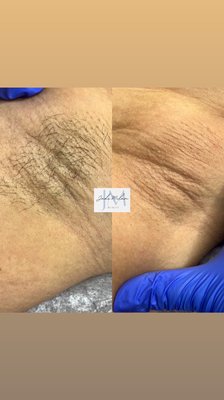 Underarm Wax - Underarm wax on new and existing clients Underarm Wax - Underarm wax on new and existing clients