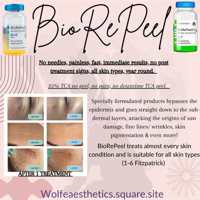 BIOREPEEL Advanced Exfoliation from Italy! - ADVANCED EXFOLIATION.
35% TCA peel that doesn’t make you peel.
You get the benefits of a TCA Peel without the downtime. This peel has Biphasic technology that drives ingredients deep into the skin and is a perfect combination with a Dermaplane Treatment to help the peel penetrate even deeper.
Helps with Fine lines, Wrinkles, Melasma, Hyperpigmentation, Acne Scars, Acne Marks, Non-inflamed Acne, Inflamed Acne, Texture, Large Pores & Dullness.
Can be applied year round and on all skin colors. BIOREPEEL Advanced Exfoliation from Italy! - ADVANCED EXFOLIATION.
35% TCA peel that doesn’t make you peel.
You get the benefits of a TCA Peel without the downtime. This peel has Biphasic technology that drives ingredients deep into the skin and is a perfect combination with a Dermaplane Treatment to help the peel penetrate even deeper.
Helps with Fine lines, Wrinkles, Melasma, Hyperpigmentation, Acne Scars, Acne Marks, Non-inflamed Acne, Inflamed Acne, Texture, Large Pores & Dullness.
Can be applied year round and on all skin colors.