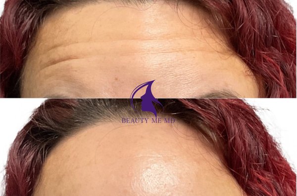 Botox - At Beauty Me MD, one of our treatment specialties is wrinkle reduction for our patients. There are a number of treatments one can choose from to deal with moderate to severe wrinkles. We hold a number of different products that our patients choose from for there wrinkle/cosmetic needs including Botox and Dysport!
